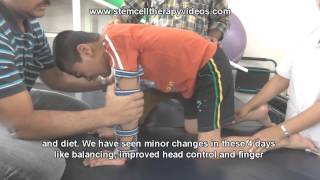 Treatment for Dystonic Cerebral Palsy [upl. by Treve]