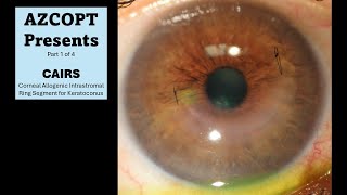 CAIRS Corneal Allogenic Intrastromal Ring Segment Case 1 [upl. by Eldrida]