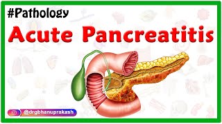 Acute Pancreatitis Etiology  signs and Symptoms pathophysiology  Diagnosis Treatment [upl. by Lovmilla]