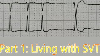 HEARTRATE of 250 Living with AVNRTSupraventricular Tachycardia SVT Part 1 [upl. by Sifan]