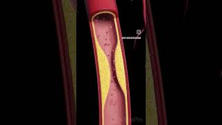 Arteriosclerosis means “hardening of the arteries” [upl. by Getraer484]