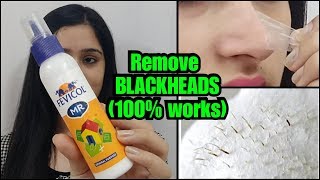 HOW TO REMOVE BLACKHEADS PERMANENTLY  EASY AND PAINLESS METHOD [upl. by Anuaik]