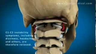 C1 and C2 Atlantoaxial Instability Upper Cervical Instability and Prolotherapy animation [upl. by Plate]