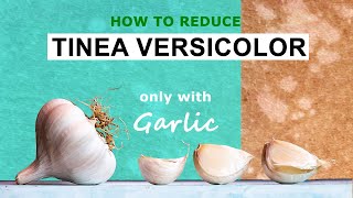 How to Reduce Tinea Versicolor Skin Only With Garlic [upl. by Balliol]