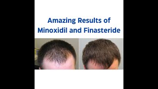 Minoxidil and Finasteride 5 Topical Solution  Before and After Result  One Month Journey [upl. by Llirred]