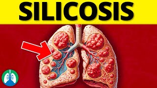 What is Silicosis EXPLAINED [upl. by Donela]