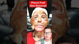 TW SHOCKING PHENOL PEEL Skin Removal shorts [upl. by Raynard]