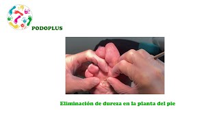 Tratamiento de la hiperqueratosis o clavo en la planta del pie [upl. by Yras]