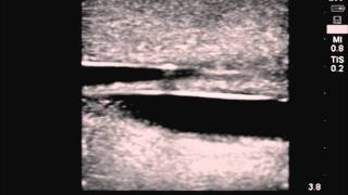 Transparent Ultrasound CVC Training Model [upl. by Drarej894]