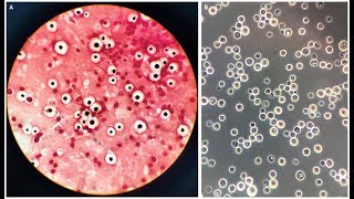 Cryptococcus neoformans Meningoencephalitis [upl. by Ward]