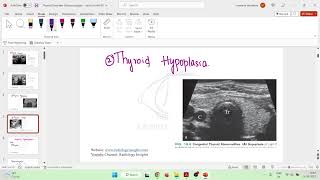 Congenital Thyroid Abnormalities  Thyroid Ultrasound  Rumack Diagnostic Ultrasound [upl. by Aenil]