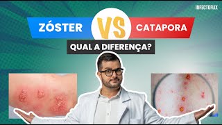 Herpes Zóster e Catapora são a mesma coisa [upl. by Lorrad640]