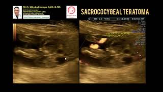 Fetus in Fetu Parasitic Twins Sacrococcygeal Teratoma [upl. by Ardnek]