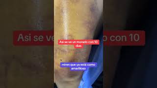 Lipo brazosplasticsurgery cirugiaplasticasegura youtubeshorts mujeres cirugiasplasticas [upl. by Hare]