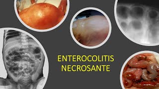 Enterocolitis necrosante [upl. by Nnylaj943]