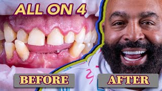 All on 4 Dental Implants Before amp After Smile Transformations  My New Smile Dental [upl. by Abehshtab]