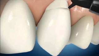 Bonding Tooth Brush Abrasion Repair [upl. by Boyden]