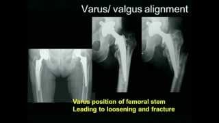 Biomechanics of the Hip Joint [upl. by Bearnard]