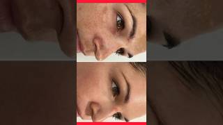 😍Remove dark spotsand pigmentationfine lines treatment at homeshorts skincareshortsfeed [upl. by Asilla804]