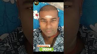 REVEALING MY HAIR TRANSPLANT JOURNEY 💥🔥 F2HairTransplantandSkinCare clinic Velachery Chennai [upl. by Rivkah339]