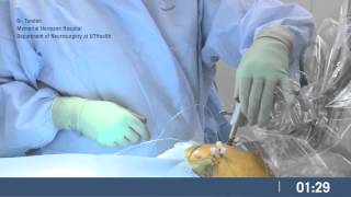 PMT sEEG Implant Surgical Procedure [upl. by Kitchen]