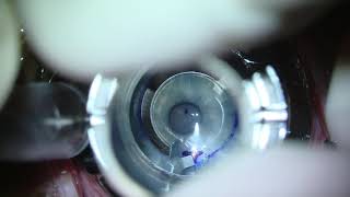 Manual Intacs Implantation for Keratoconus [upl. by Haissi]