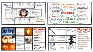 Myopia  Full Tutorial Introduction Classification Clinical Features and Management [upl. by Moth]