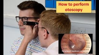 How to perform Otoscopy Ear Exam [upl. by Afihtan]