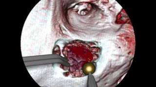 Enhancing Realism of Wet Surfaces in Temporal Bone Surgical Simulation [upl. by Trelu918]