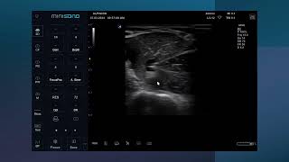 Ultrasound guided Axillary brachial plexus nerve block [upl. by Sisxela941]