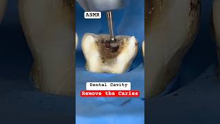 Remove the Caries cavity teethsmiledrmassidental [upl. by Sparke]