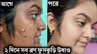 ২ দিনে সব ব্রণ ফুসকুড়ি উধাও  How To Remove Acne Pimple [upl. by Doro154]