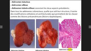tumeurs épithélials 1 [upl. by Trixie]
