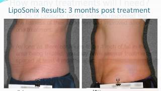 LipoSonix for Fat Reduction [upl. by Leanna]