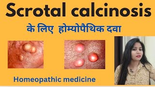 Scrotal calcinosis treatment  Scrotal calcinosis symptomscauses amp homeopathic medicine in hindi [upl. by Lled]