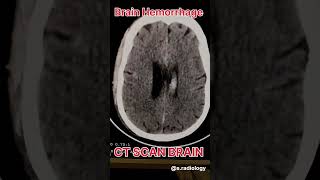 Brain Hemorrhage ct scan radiological [upl. by Yvonne]