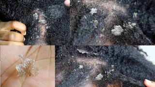 My Seborrheic Dermatitis my scalp up close [upl. by Ahsile]