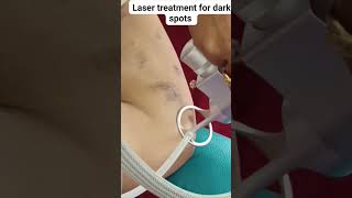 Laser treatment for dark spots [upl. by Addiego]