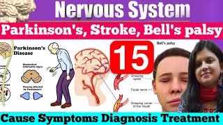 Bells palsy Parkinson’s Stroke  CVA Cerebrovascular Disease Cause Symptoms Diagnosis Treatment [upl. by Spalding]