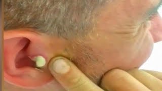 Squeezing Roufas Big Ear Pimple Medical Case Study 👍👍👍👍 [upl. by Zavala610]