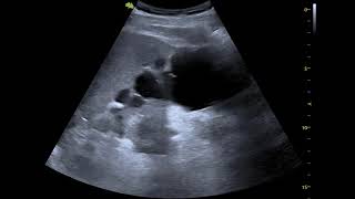 polycystic kidney disease on ultrasound [upl. by Call]