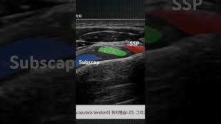 Coracohumeral ligament를 알면 오십견이 보입니다 [upl. by Fernald]