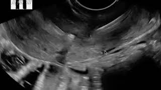 IUD on ultrasound  Jefferson hospital [upl. by Charmian883]