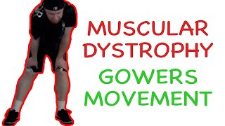 Muscular Dystrophy Gowers Maneuver [upl. by Eiramyma]