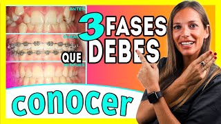 Brackets proceso 𝗠𝗘𝗦 𝗮 𝗠𝗘𝗦 📆 Las ③ 𝐄𝐓𝐀𝐏𝐀𝐒 del TRATAMIENTO de Ortodoncia  Te lo explico ✅ＦÁＣＩＬ [upl. by Edlin]