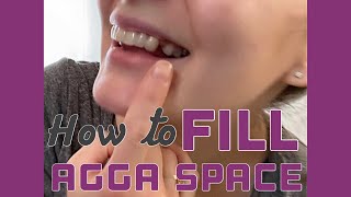 How to Fill The AGGA Space  Restorative amp Orthodontic Options [upl. by Barr229]