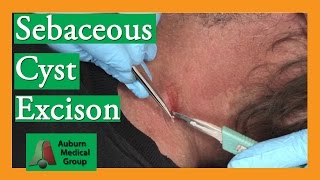 Sebaceous Cyst Removal  Auburn Medical Group [upl. by Ioves]