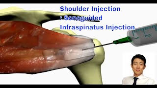 Shoulder Injection Therapy The Ultrasoundguided Approach for Infraspinatus [upl. by Azile]