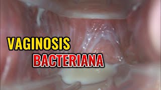 Vaginosis bacteriana  Dr Esteban Contreras [upl. by Goodhen]