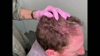 MicroNeedling for Hair Restoration [upl. by Lenhart]